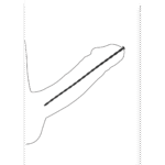 Urethrale set met spiraalschroef – Beginners - Afbeelding 4